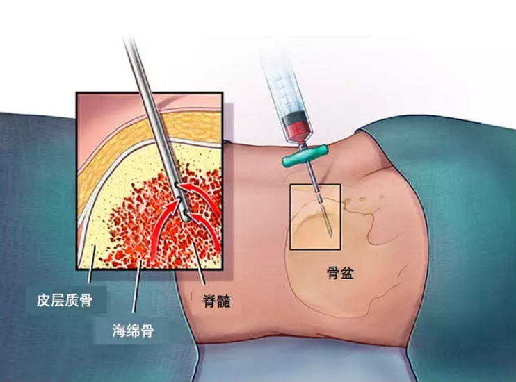 穿刺针冲压厂家